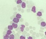 Es busca un donant de medul·la per a un nen de Ripollet que pateix leucèmia.